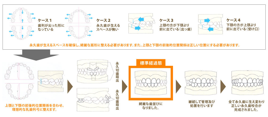 小児矯正の手順 可児市 おくだ歯科 小児矯正歯科