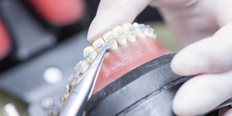 歯に矯正に必要な装置をつけている写真