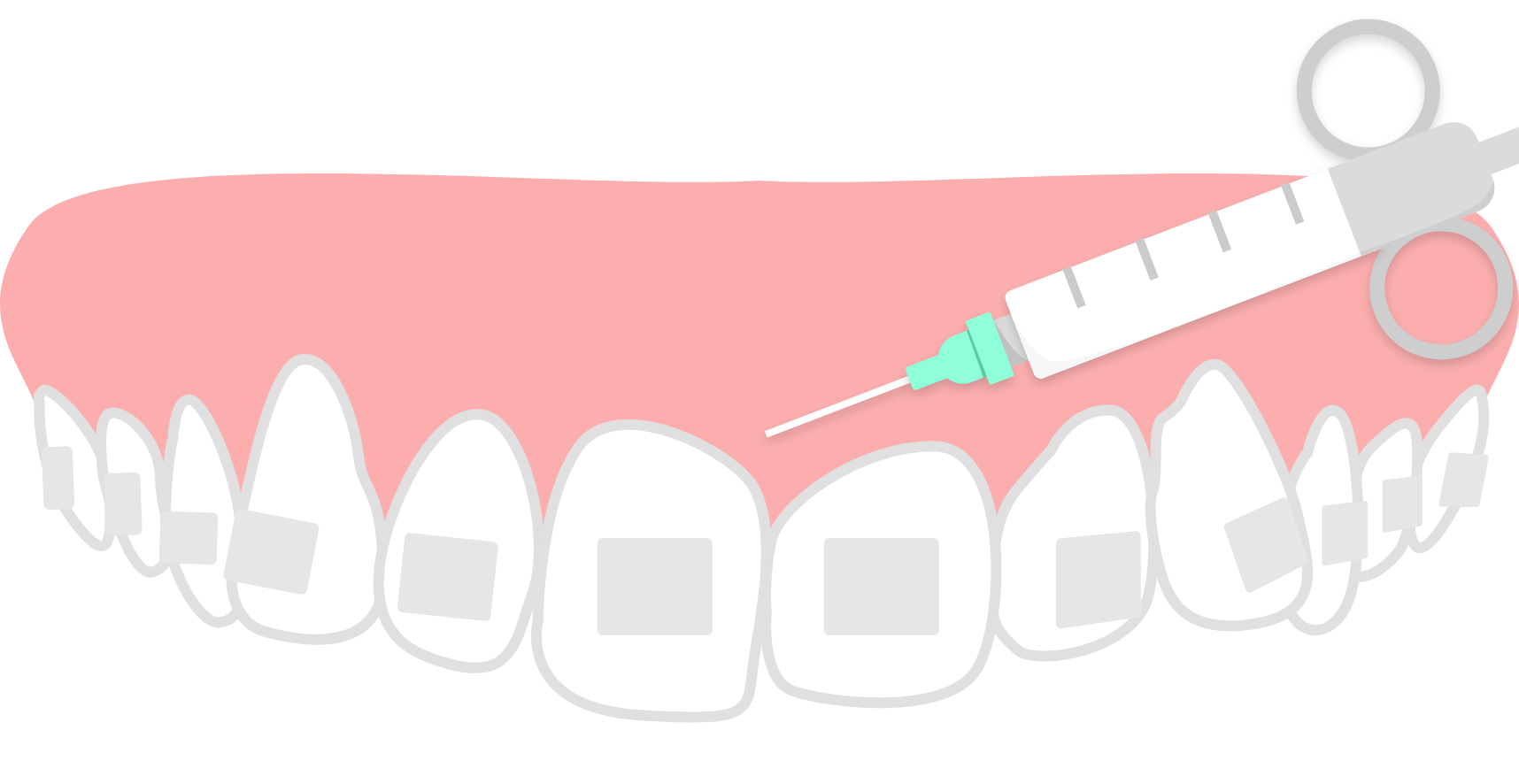 歯茎にあたる部分に麻酔注射をするイラスト