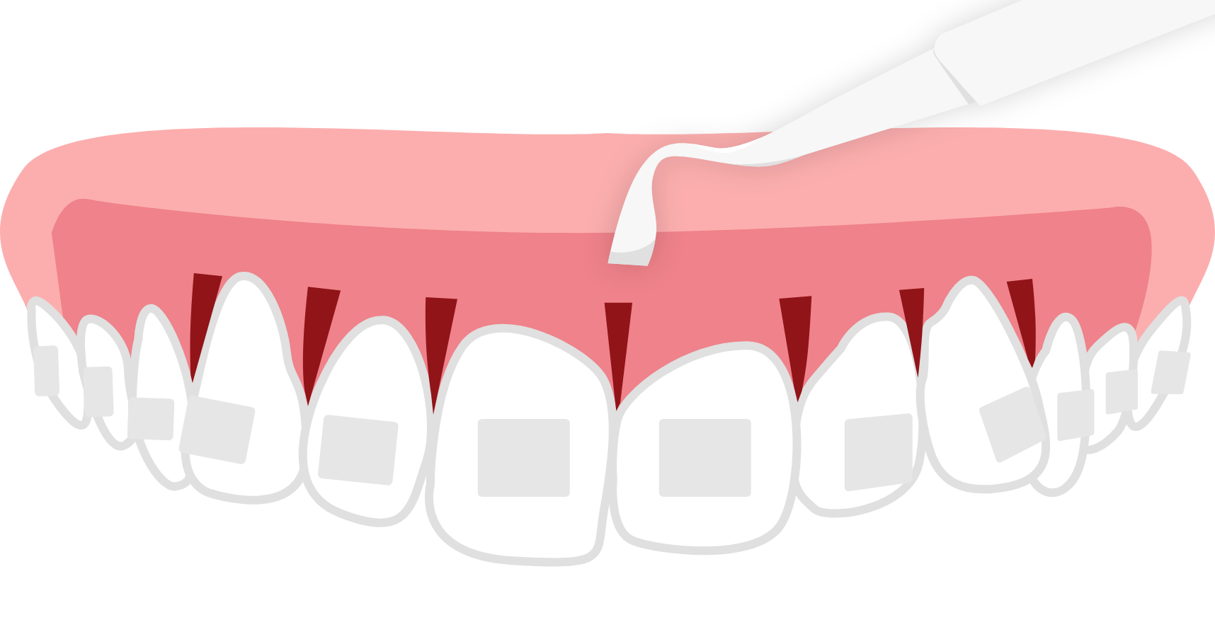 器具を用いて切開した部分に切り込みを入れているイラスト