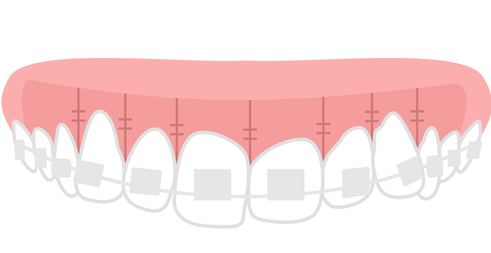 歯茎を縫合し、矯正器具を歯に装着したイラスト