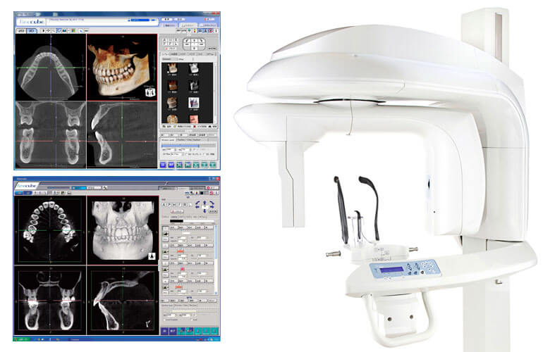 歯の根の状態を正確に把握する歯科用CT