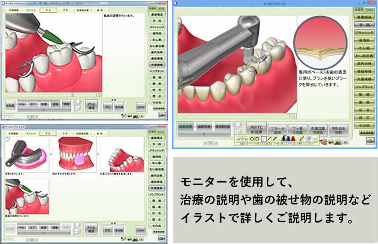 デンタルフラッシュ