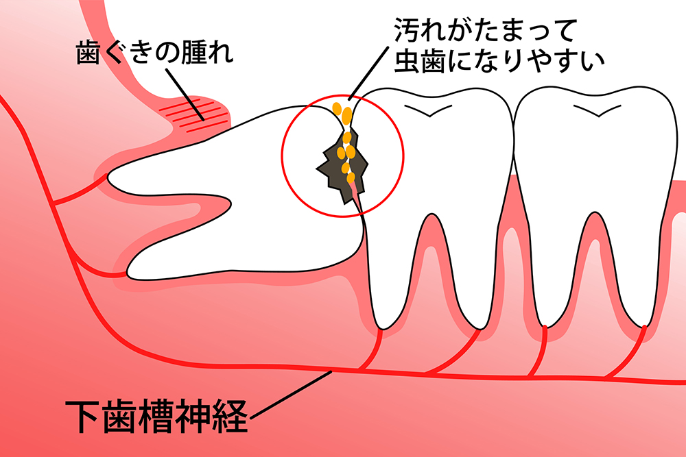 親知らずが痛い…その痛みを放置していると…