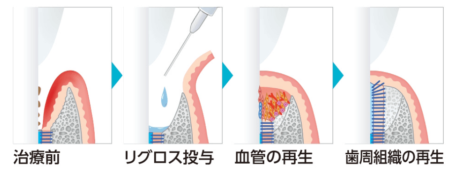 リグロスによる歯周組織の再生