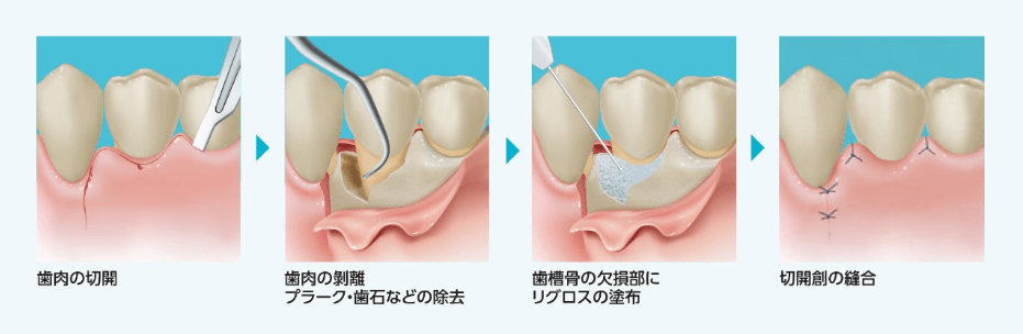 フラップ手術におけるリグロスの塗布